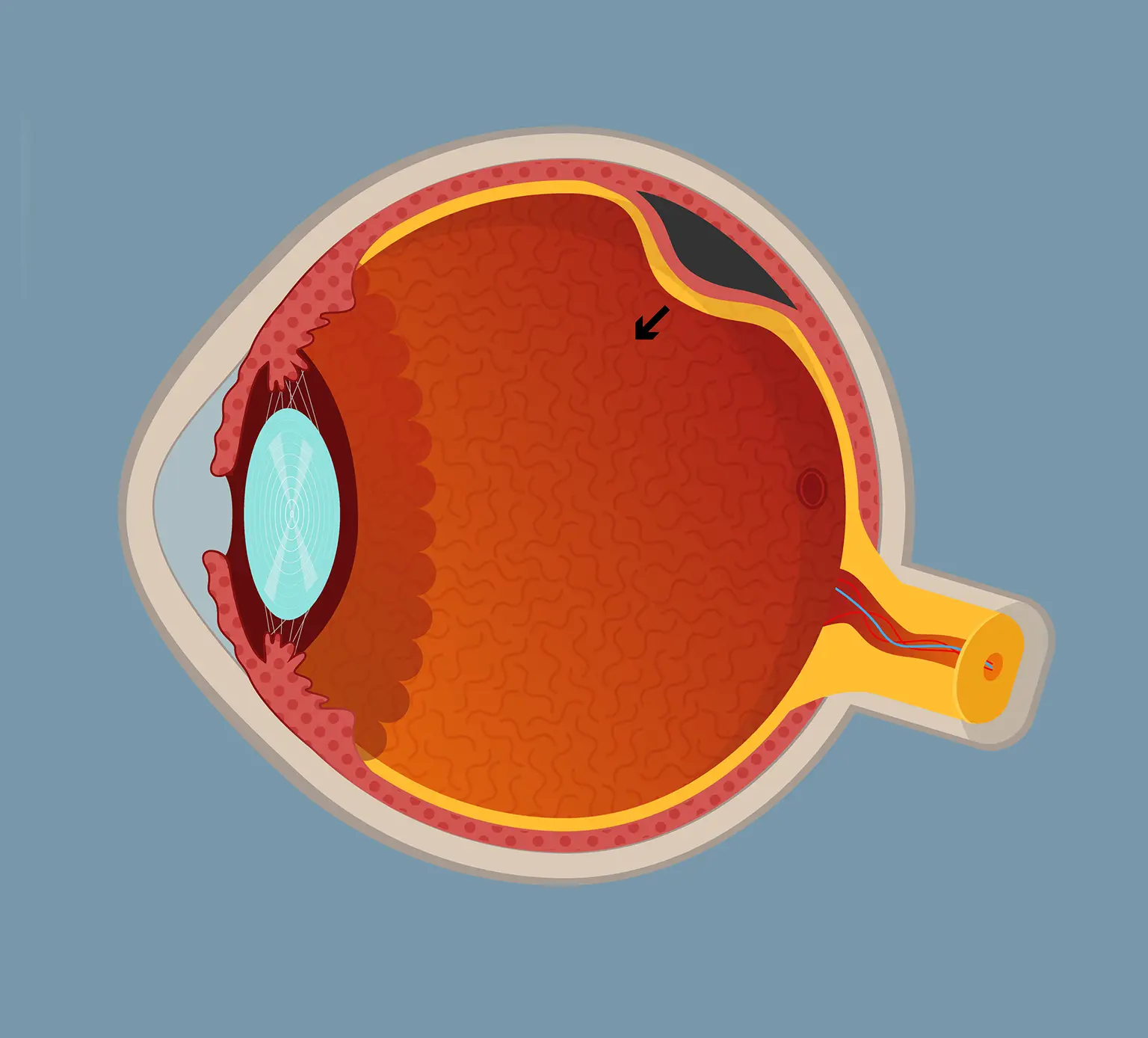 risk factors of retinal detachment - Asia Pacific Eye Centre