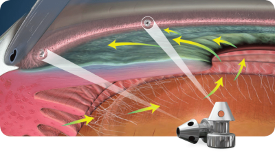 Glaucoma-iStent-Inject-Process-Animation-1024x580
