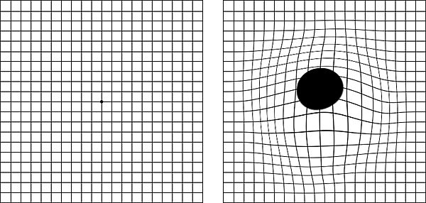 Macular Degeneration Eye Chart Grid