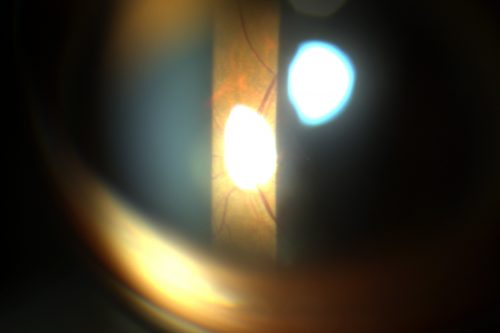 Asia Pacific Eye Centre Retinal Tear Image Slit Lamp