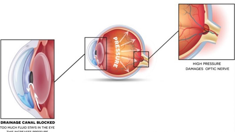glaucomaN
